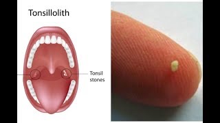 Tonsilloliths tonsil stones a patient education video by Carlo Oller MD [upl. by Kcire655]