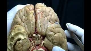 NEUROANATOMÍA 20 DISECCIÓN DE LA CARA VENTRAL DEL ENCÉFALO LÓBULO TEMPORAL 1 [upl. by Leftwich]