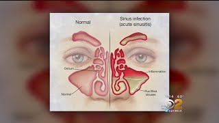 Doctor Tried And True Methods For Sinus Relief Are Still Best [upl. by Sulihpoeht]