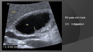 Adenomyomatosis of gallbladder [upl. by Ax]