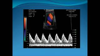 Obstetric Doppler Part 1 [upl. by Retsim]