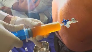 Thoracentesis procedure  Remove pleural effusion [upl. by Naahs135]