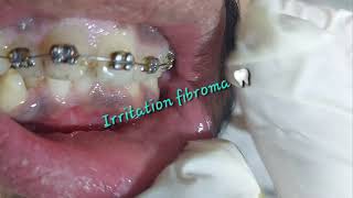 Oral benign asymptomatic prolonged irritation fibroma caused by cheek biting rubbing from teeth [upl. by Draneb]