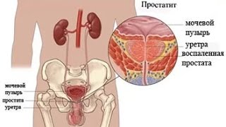 Хронический простатит  причины симптомы и лечение [upl. by Leind495]