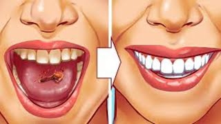 9 Natural Ways to Remove Plaque amp Tartar Buildup  Say Goodbye to Dental Problems [upl. by Janina307]