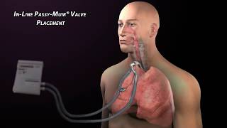 Passy Muir Valve with Mechanical Ventilation [upl. by Pacian386]