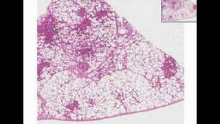 Histopathology LungBronchopneumonia [upl. by Wehhtam]