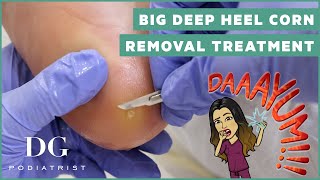 Big deep satisfying heel corn removal treatment on the foot  DG Podiatrist [upl. by Gnaig802]