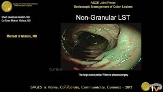 The large polyp When to choose EMR ESD surgery [upl. by Teak]