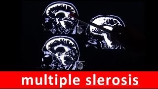 multiple sclerosis MS chronic autoimmune disease in MRI scan by RadiologyTV [upl. by Naashom]