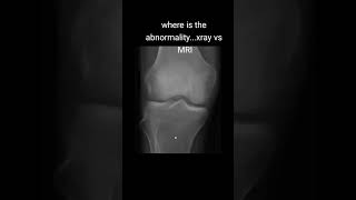 radiology التشخيصالطبي medicalconsultation radiologylife fracture [upl. by Yeca]