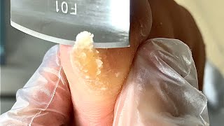 Callus removal from feetampFoot scraping dead skin【Xiao Yan pedicure】stress 3 [upl. by Lorrin]