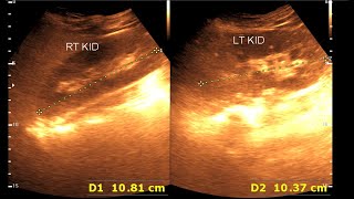 Fatty infiltration of the liver  Kidney Stone [upl. by Ateekan]