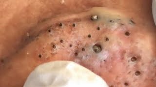 Big Cystic Acne Blackheads Extraction Blackheads amp Milia Whiteheads Removal Pimple Popping  5757 [upl. by Nauqit]