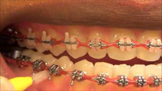 111 HOW TO USE MY INTERDENTAL TOOTHPICKS WITH BRACES ON [upl. by Eenahc]