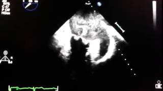 Transesophageal echocardiogram  spontaneous contrast [upl. by Grimbald]