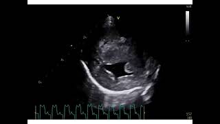 Neonatal hypertension Eisenmenger syndrome following a perimembranous ventricular septal defect [upl. by Dow]