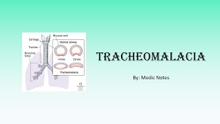 Tracheomalacia  clinical features investigation treatment and management [upl. by Clayberg]