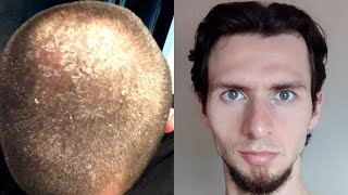 8 years no shampoo results [upl. by Jeromy]