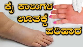 Edema Treatment  How To Cure Swelling In Hands amp Legs  ನೀರು ತುಂಬಿಕೊಂಡು ಮೈ ಕೈ ಊತ ನಿವಾರಣೆ ಹೇಗೆ [upl. by Malva]