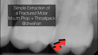 Placing a Throatpack for a Dental Extraction drwahan [upl. by Cleopatra]