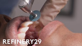 I Got A Professional Tooth Restoration  Macro Beauty  Refinery29 [upl. by Ylera926]