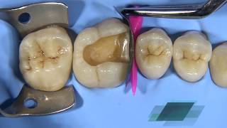 Cusp BuildUp of a Molar with Gænial™ Universal Injectable [upl. by Airenahs]