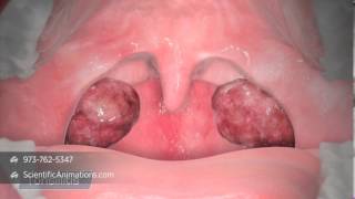 3D Medical Illustration of Tonsils  Tonsillitis Animation  ENT Animation [upl. by Madelaine]