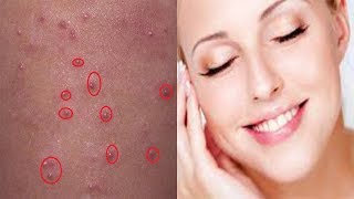 What is Molluscum Contagiosum Symptoms Treatment [upl. by Alledi170]