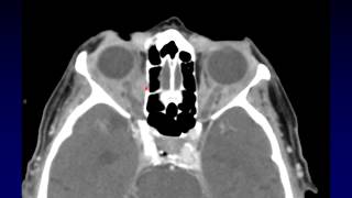 Imaging of the Eye and Orbit Part 4 [upl. by Sevein]