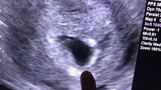 Sonogram 6 weeks pregnant [upl. by Eiahpets155]