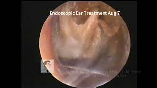 Similarities between cholesteatoma and cerumen embolism 20230807 [upl. by Ahtael741]