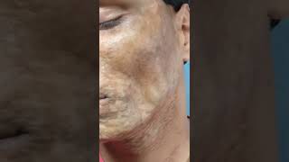 Morphea  Scleroderma  एक साधारण बीमारी भी इलाज के अभाव में काफी ख़तरनाक रूप ले सकती है  morphea [upl. by Tristas]