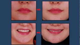 EngVer Korean Plastic Surgery Mouth corner lift  Smile Lipt [upl. by Feeney]