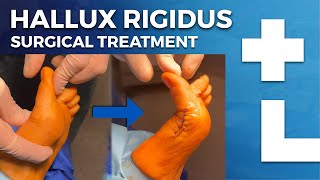 Hallux rigidus surgery  cheilectomy Moberg osteotomy  Dworska hospital® [upl. by Aleil]