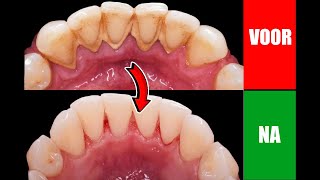 Zo verwijder je tandplak van je tanden zonder naar de tandarts te gaan [upl. by Nollat620]