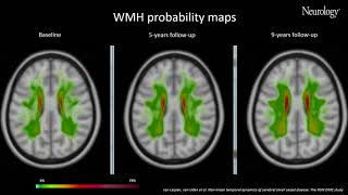 Video 1 Nonlinear temporal dynamics of cerebral small vessel disease [upl. by Eiznekam]