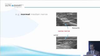 Terasons MSK Ultrasound Basics with Dr Visco Part 5 of 8 [upl. by Yc]