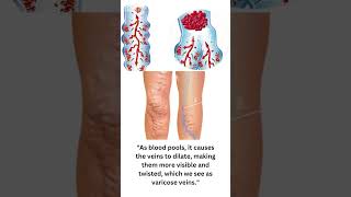 quotUnderstanding Varicose Veins Why Do Veins Dilatequot [upl. by Cassiani614]