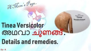 Tinea Versicolor or Pityriasis Versicolor details amp remedies [upl. by Heymann]