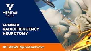 Lumbar Radiofrequency Neurotomy [upl. by Evilc]