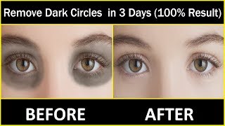 In 3 DAYS Remove Dark Circles Naturally and Permanently  100 Results [upl. by Lynnell642]