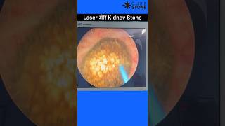 Kidney stone treatment using laser  RIRS  Retrograde intrarenal surgery shorts [upl. by Mathia964]