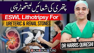 ESWL treatment for kidney stones II گردے کی پتھری کا علاج شاک ویو II Urdu Hindi [upl. by Nidroj]