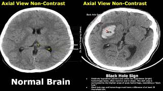 CT Scan Brain Normal Vs Hemorrhagic Stroke Images  Swirl Black Hole Blend Spot amp Island Signs [upl. by Skutchan]