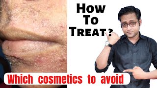 Perioral dermatitis  Cosmetics induced  Diagnosis amp treatment  Hindi [upl. by Chivers472]