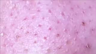 Removing Acne Blackheads on skin cleaning everywhere [upl. by Jeannie924]