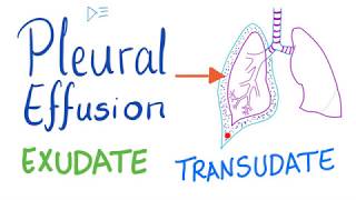 Pleural Effusion  Transudate or Exudate  Causes and Liddle’s Criteria Pulmonary Medicine Playlist [upl. by Earej]