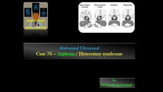 Ultrasound Case 76 Asplenia  Heterotaxy Syndrome [upl. by Enilekcaj955]