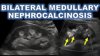 MEDULLARY NEPHROCALCINOSIS ON ULTRASOUND [upl. by Aleece818]